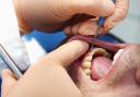 A dentist has warned using a hard toothbrush to clean retainers or Invisalign braces can be harmful